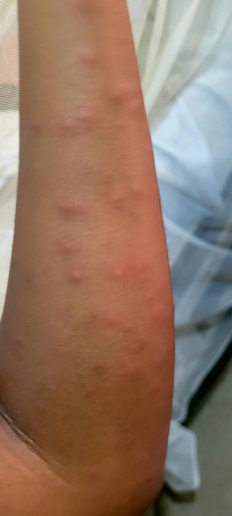 Arm showing multiple mosquito bites after living in the Dominican Republic.
